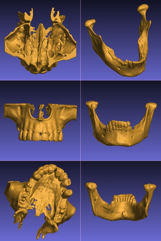 STL models of mandible and maxilla